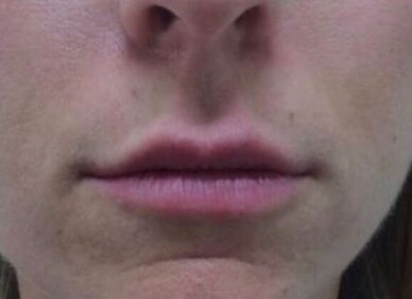 Injectables Case 20 - After