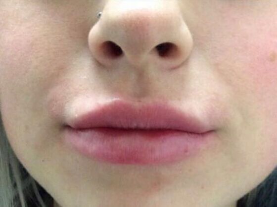 Injectables Case 21 - After