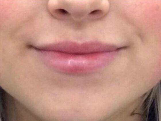 Injectables Case 21 - Before