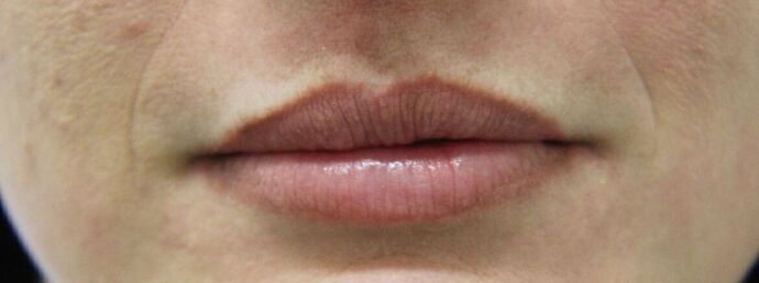 Injectables Case 23 - Before