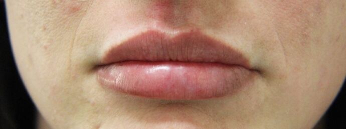 Injectables Case 23 - After