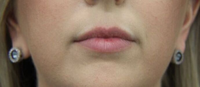 Injectables Case 24 - Before