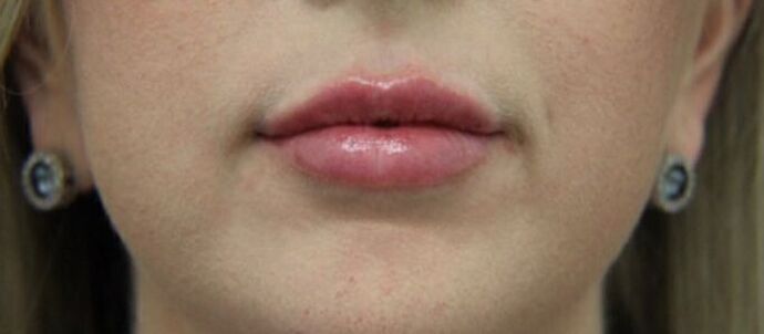 Injectables Case 24 - After