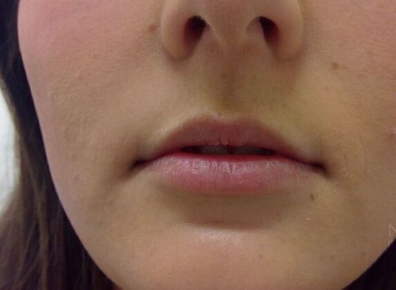 Injectables Case 26 - Before