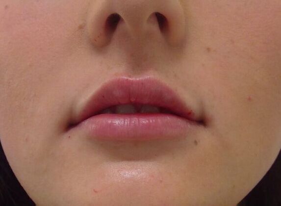 Injectables Case 26 - After