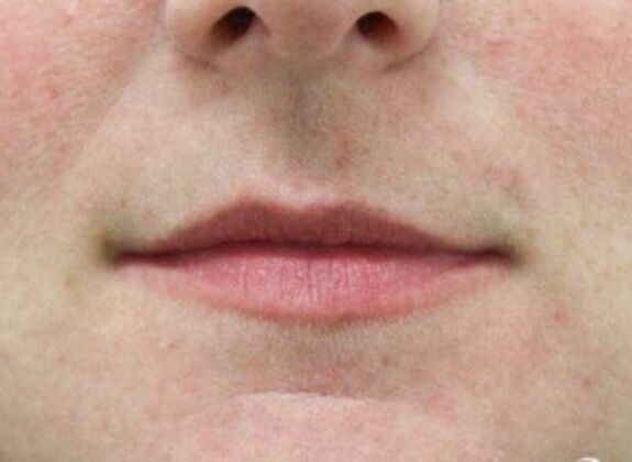 Injectables Case 27 - Before