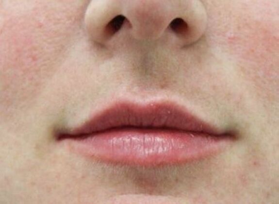 Injectables Case 27 - After