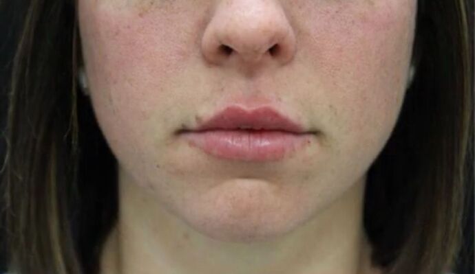 Injectables Case 28 - After