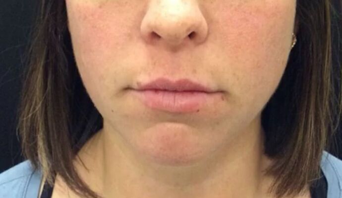 Injectables Case 28 - Before
