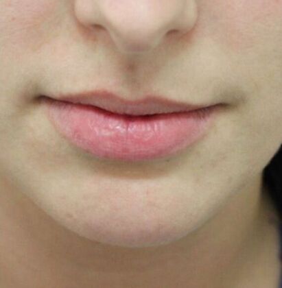 Injectables Case 30 - Before