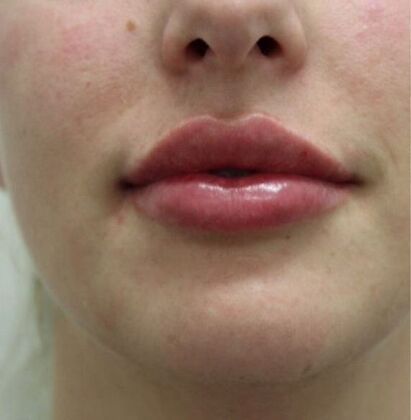 Injectables Case 30 - After