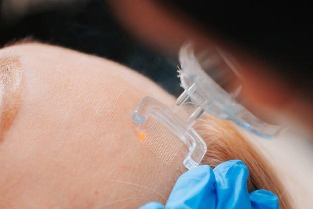 CO2 Laser Resurfacing Cases