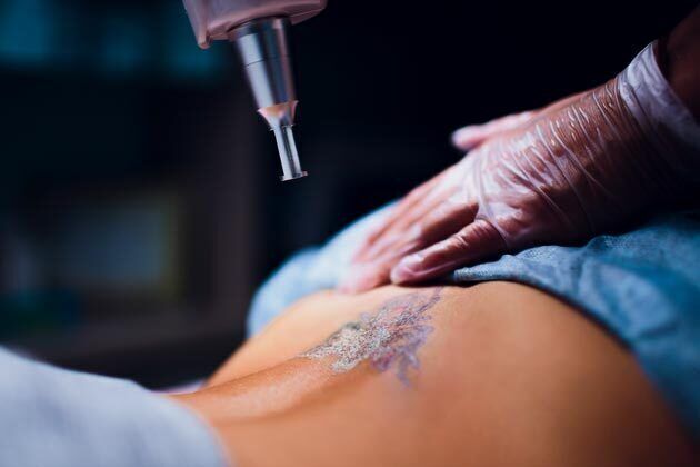 Tattoo Removal Cases