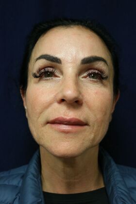 Cosmetic Tattooing: Permanent Lip, Eyeliner and Eyebrow Makeup - Before