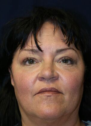 Forehead & Brow Lifts*: Case 1 - Before