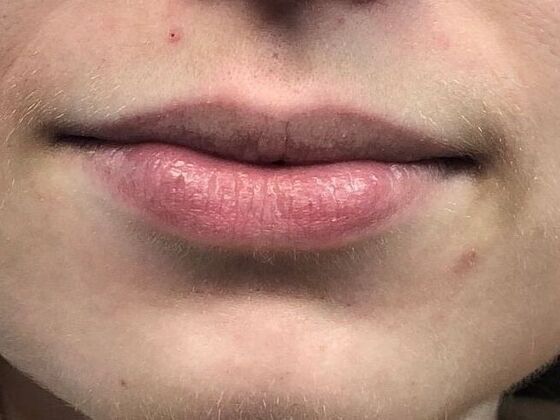 Cosmetic Injectables & Fillers*: Case 42 Lip Filler - Before