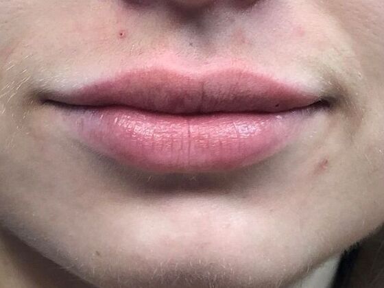 Cosmetic Injectables & Fillers*: Case 42 Lip Filler - After