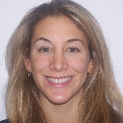 Veneers: Bri - F. - Before