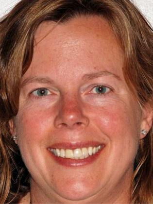 Veneers: Pam - K. - Before