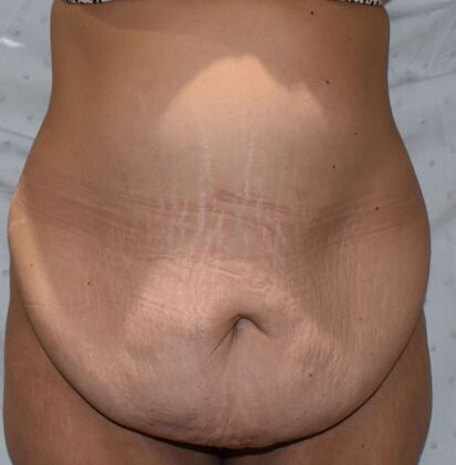 Tummy Tuck (Abdominoplasty): Case 390 - Before