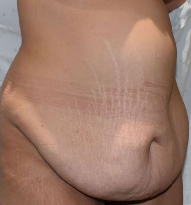 Tummy Tuck (Abdominoplasty): Case 390 - Before