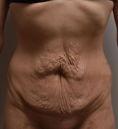 Tummy Tuck (Abdominoplasty): Case 391 - Before