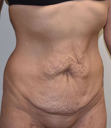 Tummy Tuck (Abdominoplasty): Case 391 - Before