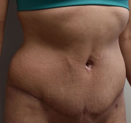 Tummy Tuck (Abdominoplasty): Case 391 - After