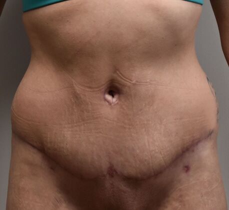 Massive Weight Loss : Case 116 - After