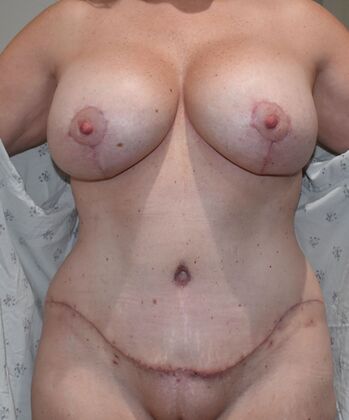 Massive Weight Loss : Case 117 - After