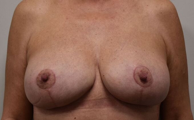 Breast Reduction: Case 147 - After
