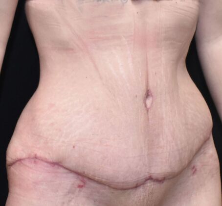 Tummy Tuck (Abdominoplasty): Case 394 - After