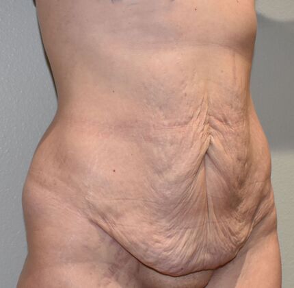 Tummy Tuck (Abdominoplasty): Case 394 - Before