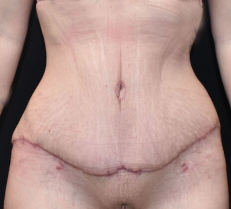 Massive Weight Loss : Case 118 - After