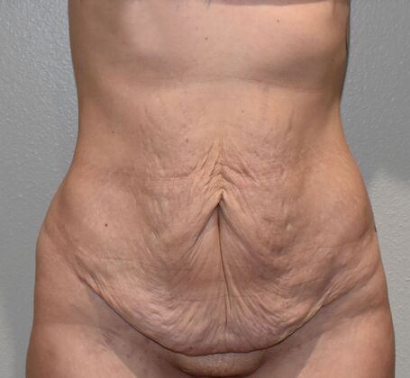 Massive Weight Loss : Case 118 - Before