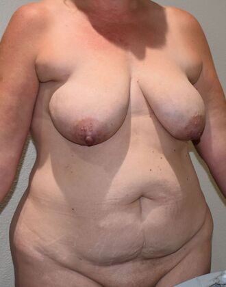 Mommy Makeover: Case 253 - Before