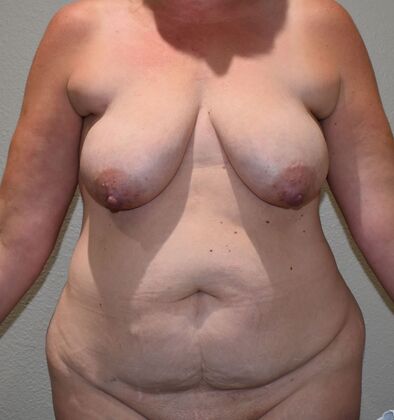 Massive Weight Loss : Case 119 - Before