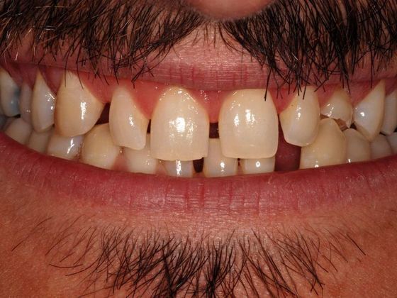 Porcelain Bridges: Matt - Before