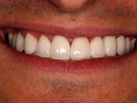 Porcelain Bridges: Matt - After