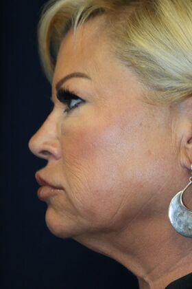 Cosmetic Injectables & Fillers*: Case 43 Jawline Filler - Before