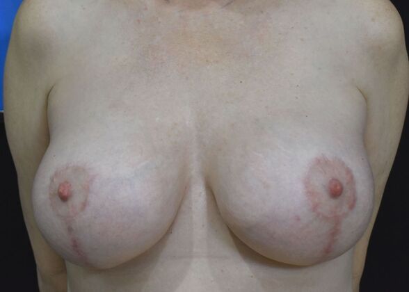 Breast Augmentation w/ Lift Case 467 - After