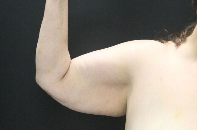 Arm Lift Case 16 - Before