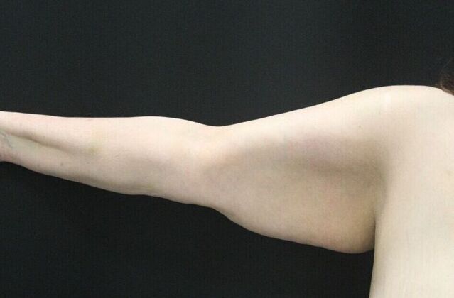 Arm Lift: Case 16 - Before