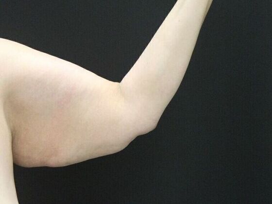 Arm Lift: Case 16 - Before