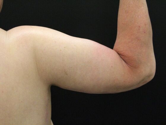 Arm Lift: Case 16 - After