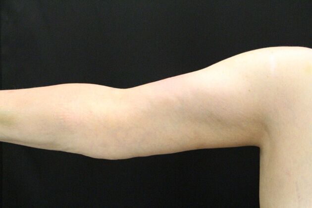 Arm Lift: Case 16 - After