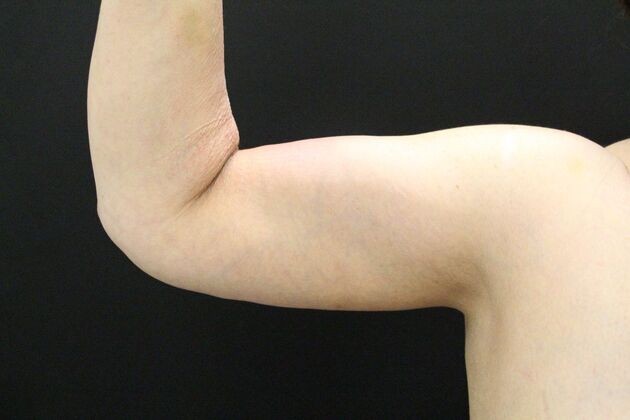 Arm Lift Case 16 - After