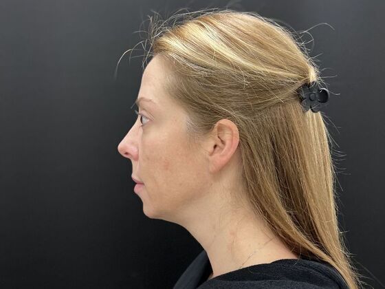 Injectables Case 31 - Before