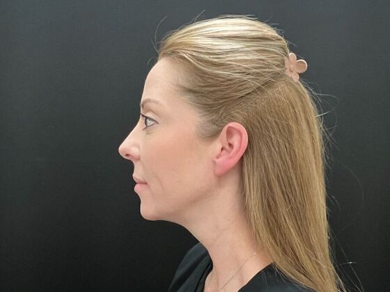 Injectables Case 31 - After