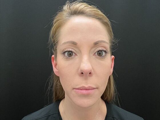 Injectables: Case 31 - After